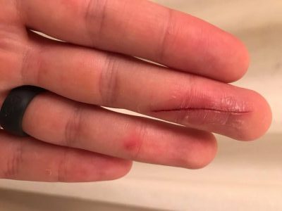 How to be a Germ Freak in the Medical Field with a Paper Cut